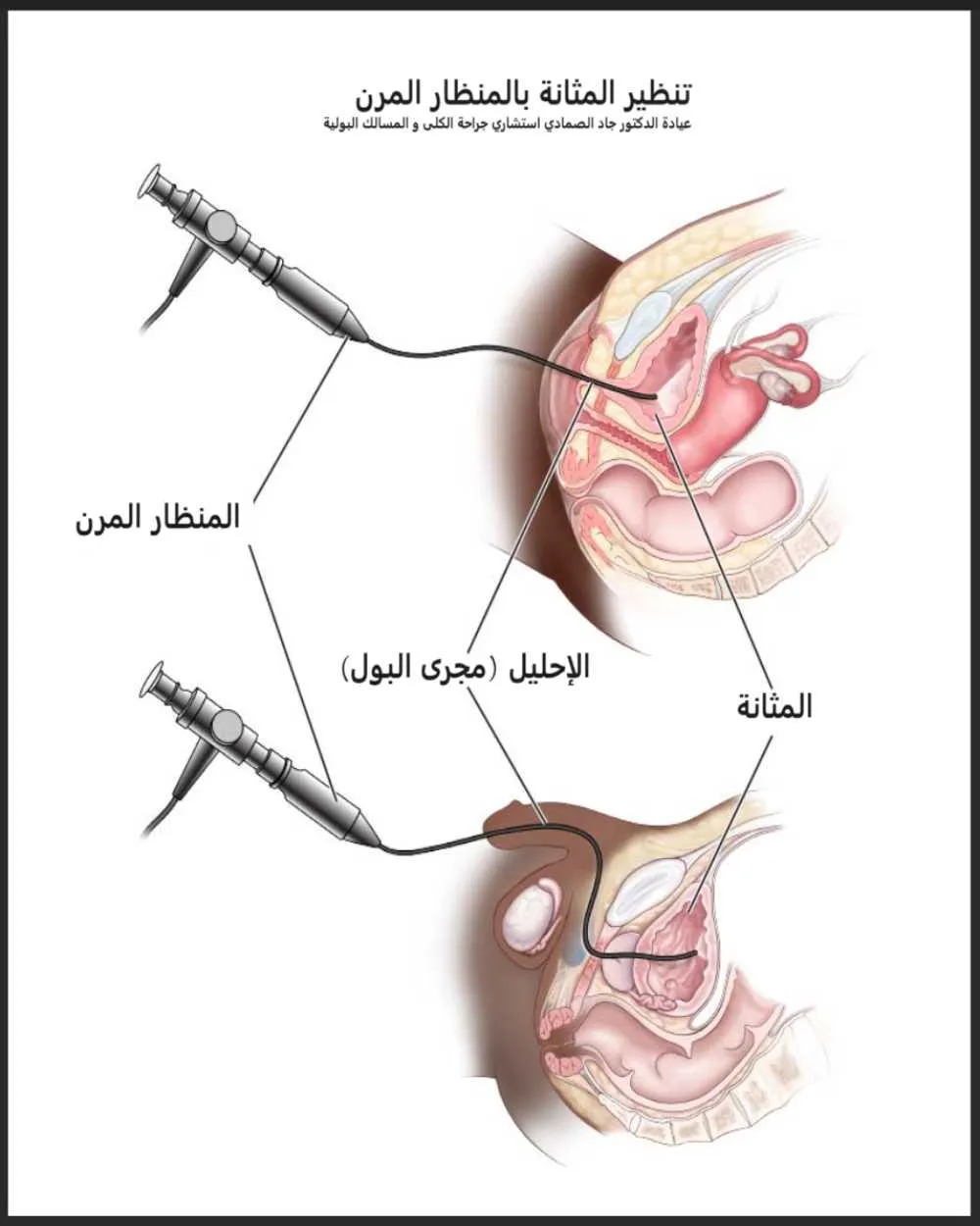   تنظير المثانة بالمنظار المرن   